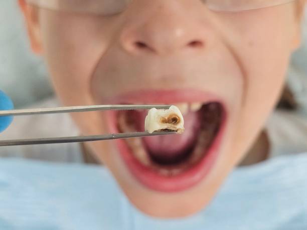 Best Emergency Dental Care for Broken or Chipped Teeth in Newton, IL